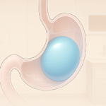 Illustratie van een maagballon in de maag die de beschikbare ruimte verkleint