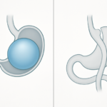 Illustratie van een maagballon naast een schematische weergave van een gastric bypass